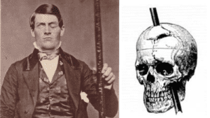 Picture of Phineas Gage and his injured brain for John R. Miles blog